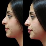 Could Nose Reshaping in Dubai Be the Right Choice for You?